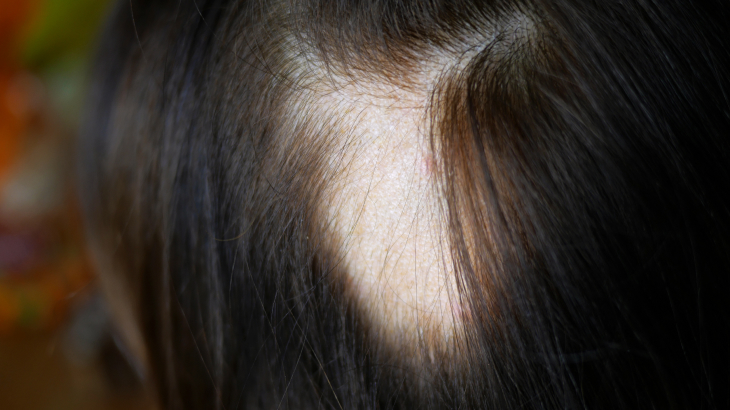 Parte da cabeça faltando cabelo